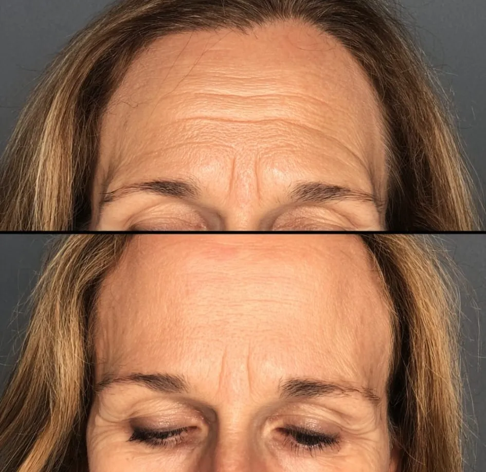 Frown lines treatment