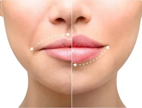 Lip Flip Botox procedure